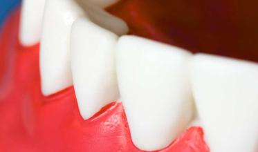 dents